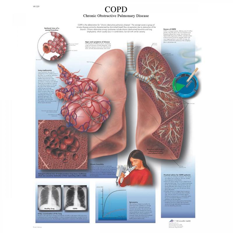 Wandkaart: COPD Chronic obstructive pulmonary disease