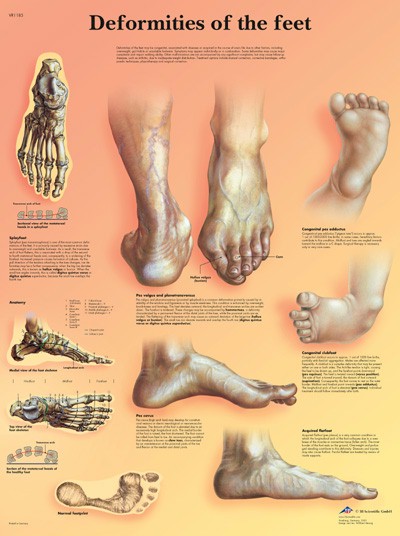 Deformities Of The Feet