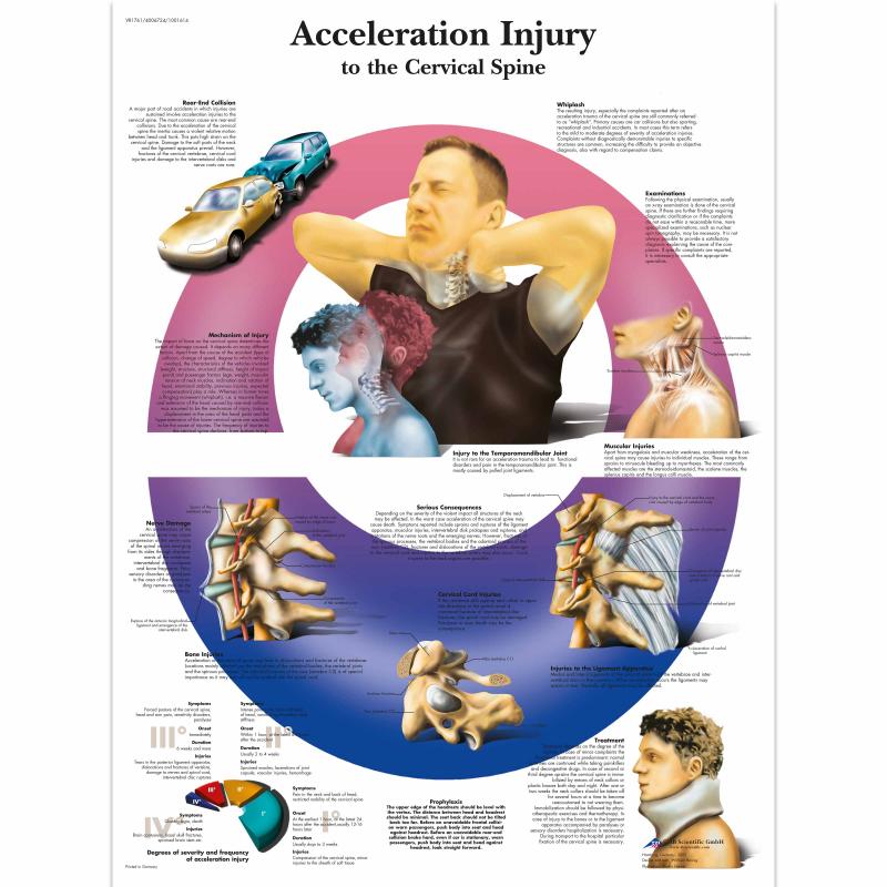 All Products - Wandkaart: Acceleration injury to the cervical spine